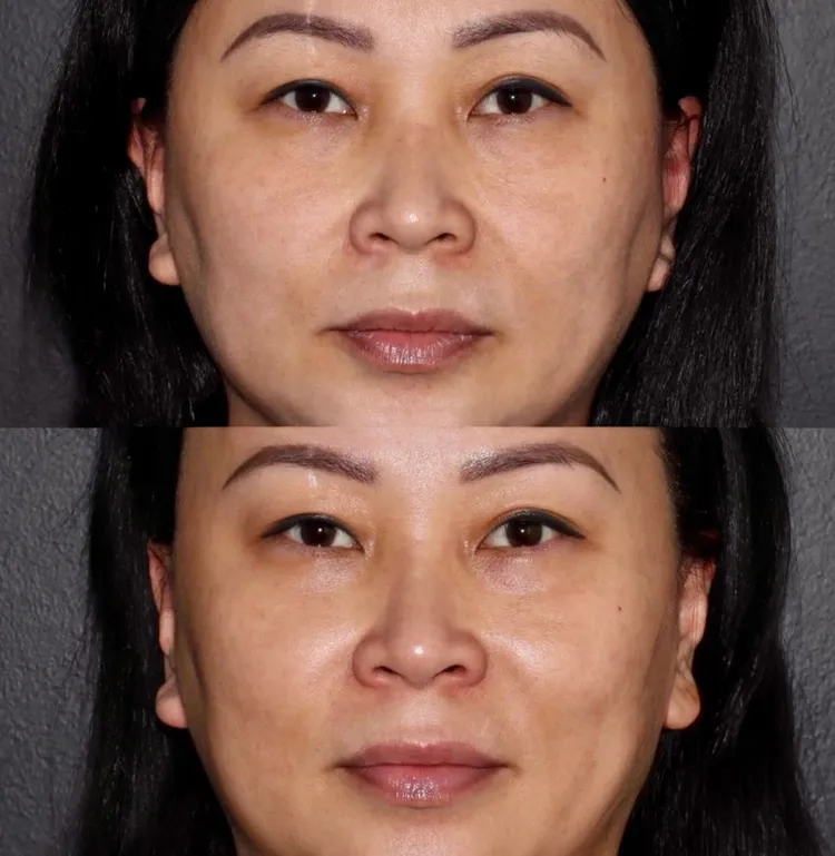 微针治疗前后对比，郭医生，卡尔加里 1