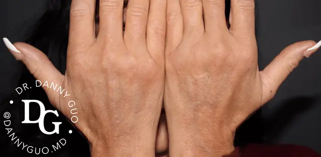 让双手重现年轻