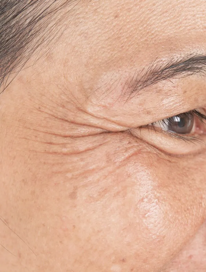 眼周细纹