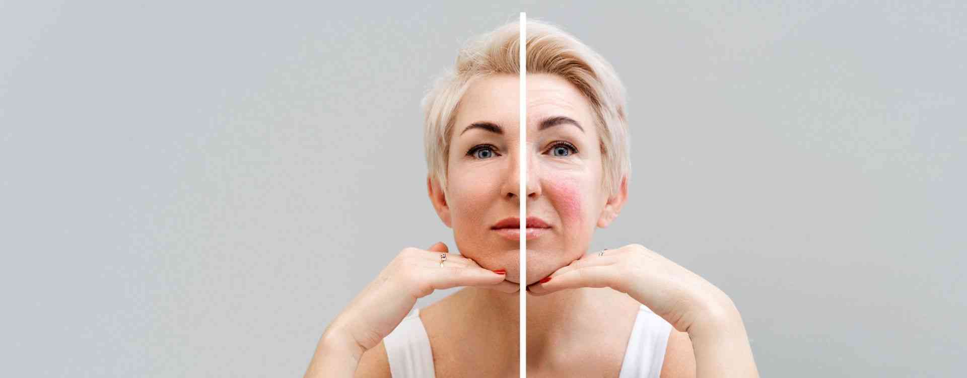 Rosacea treatment