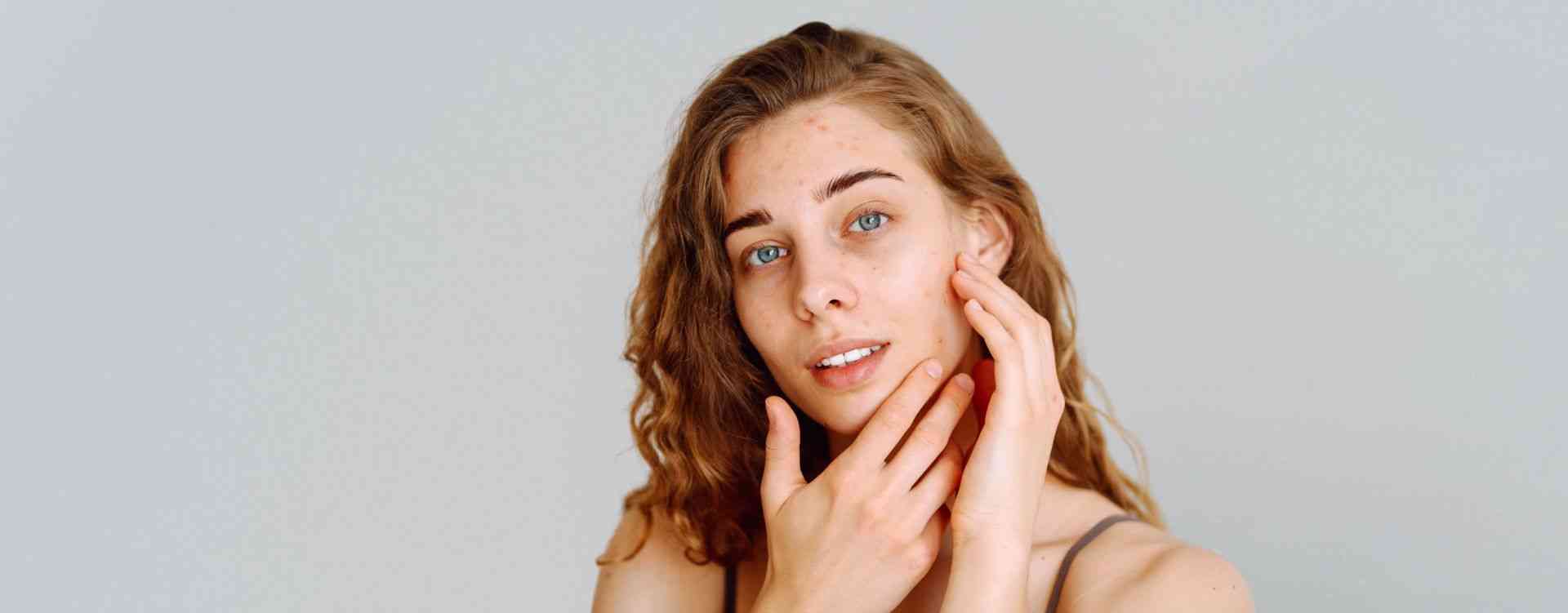 acne treatment Calgary