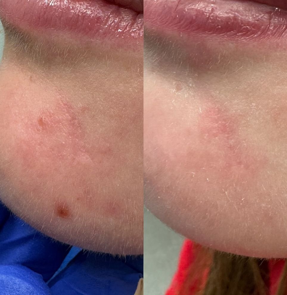 acne treatment Calgary clinic before and after