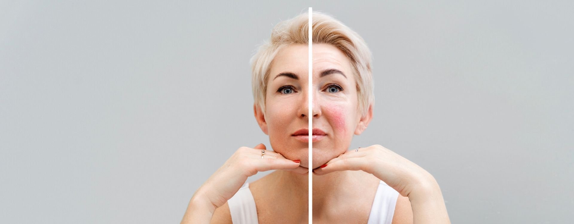 Rosacea treatment