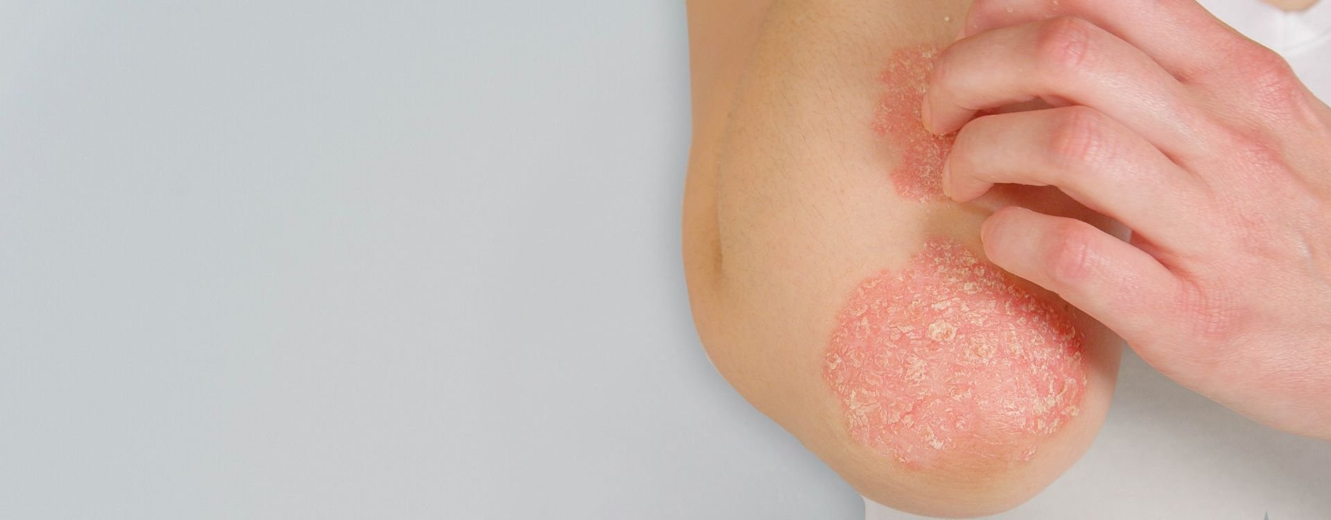 psoriasis clinic in Canada