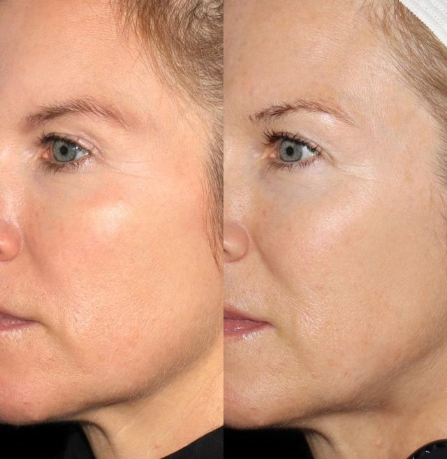 Before and after cosmetic treatment by Dr. Danny Guo